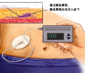 胰岛素泵-上海聚慕医疗器械有限公司